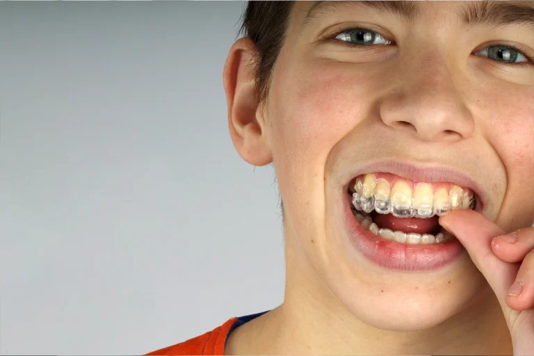 Invisalign: como limpar os meus alinhadores?